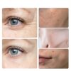 Rienan Anti Falten Pflaster Stirn Augen Tiefenreparatur-3